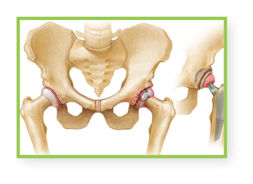 Post Hip Replacement in Banashankari
